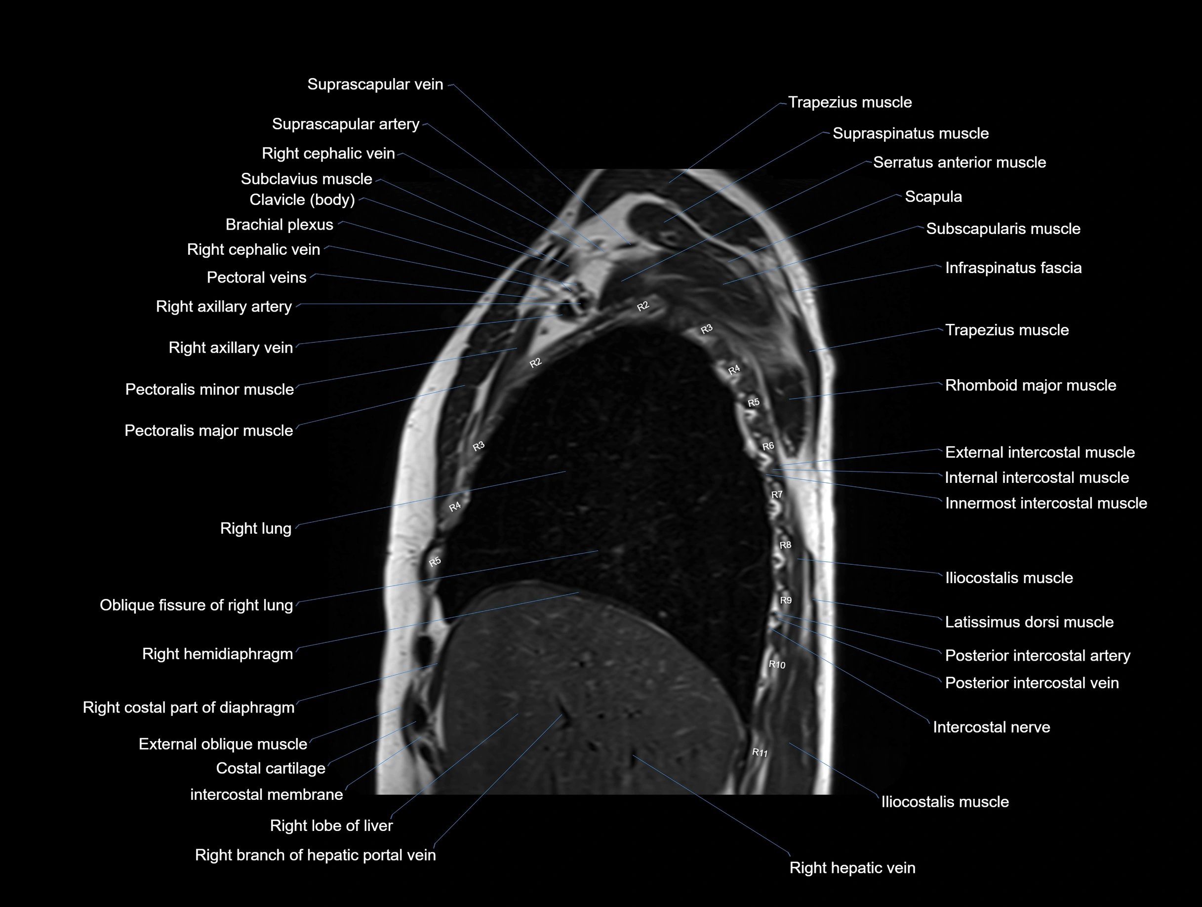 MRI chest (thorax) coronal  cross sectional anatomy 3T radiology  image-img-00001-00010.webp